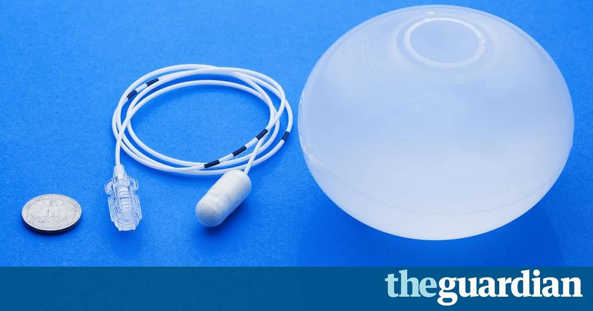 image for Swallowable gastric balloon could help the obese lose weight without surgery