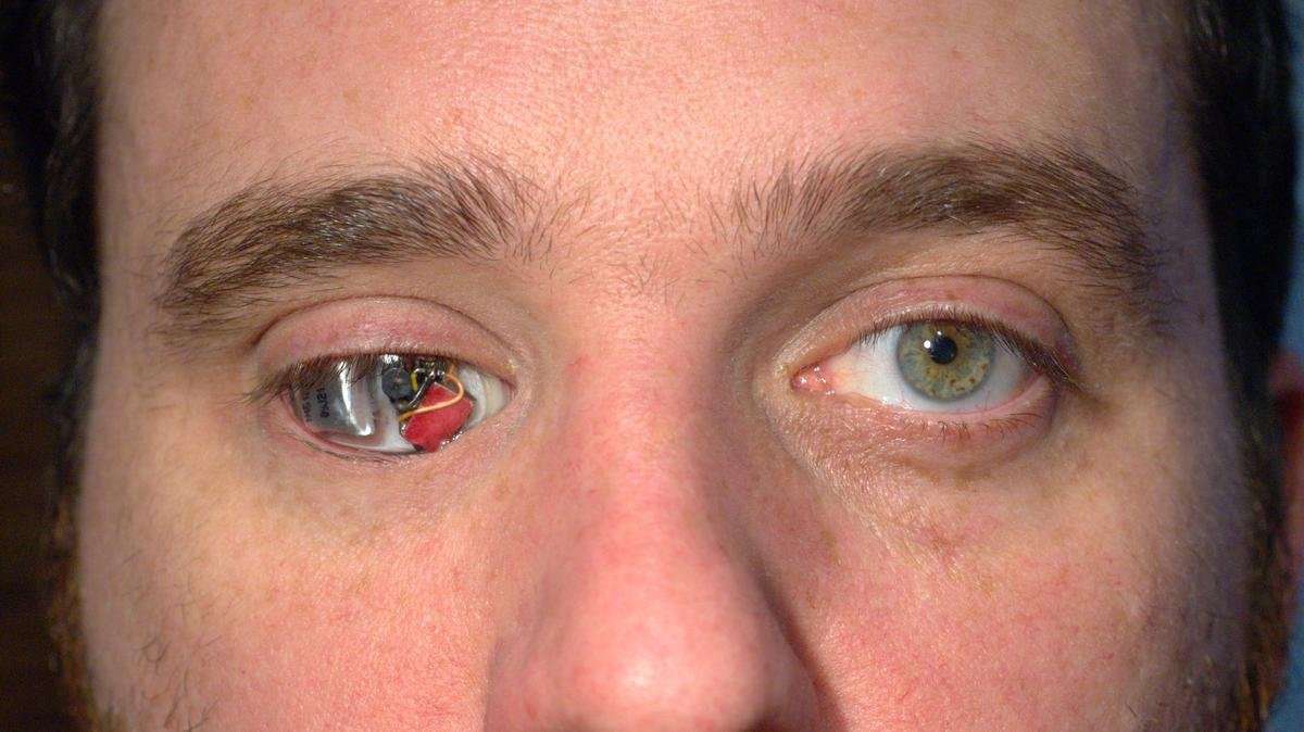 image for This Filmmaker Installed a Video Camera Into His Right Eye Socket
