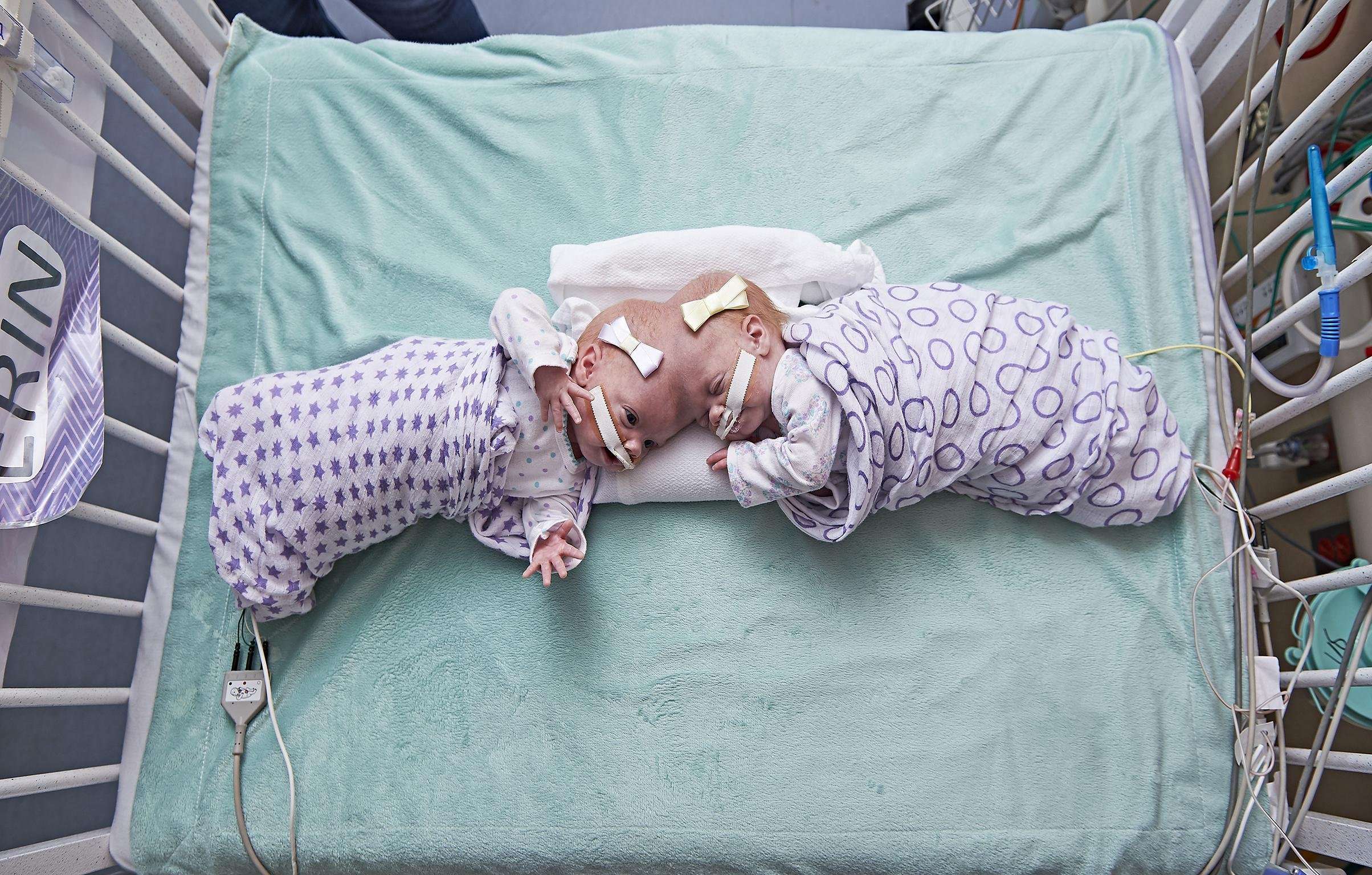 image for Twin girls conjoined at the head successfully separated by 30-strong surgical team