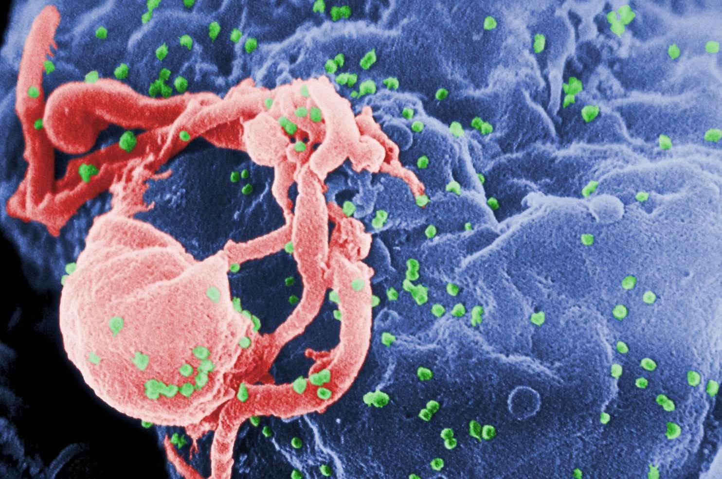 image for New hope for HIV cure as child remains virus-free years after final treatment