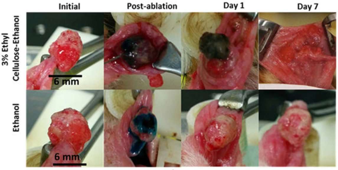 image for Ethanol: A Lethal Injection for Tumors