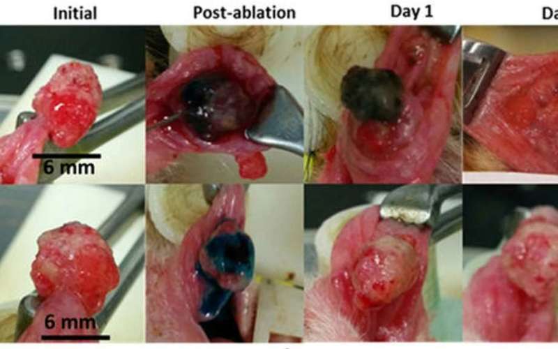 image for Ethanol: A Lethal Injection for Tumors