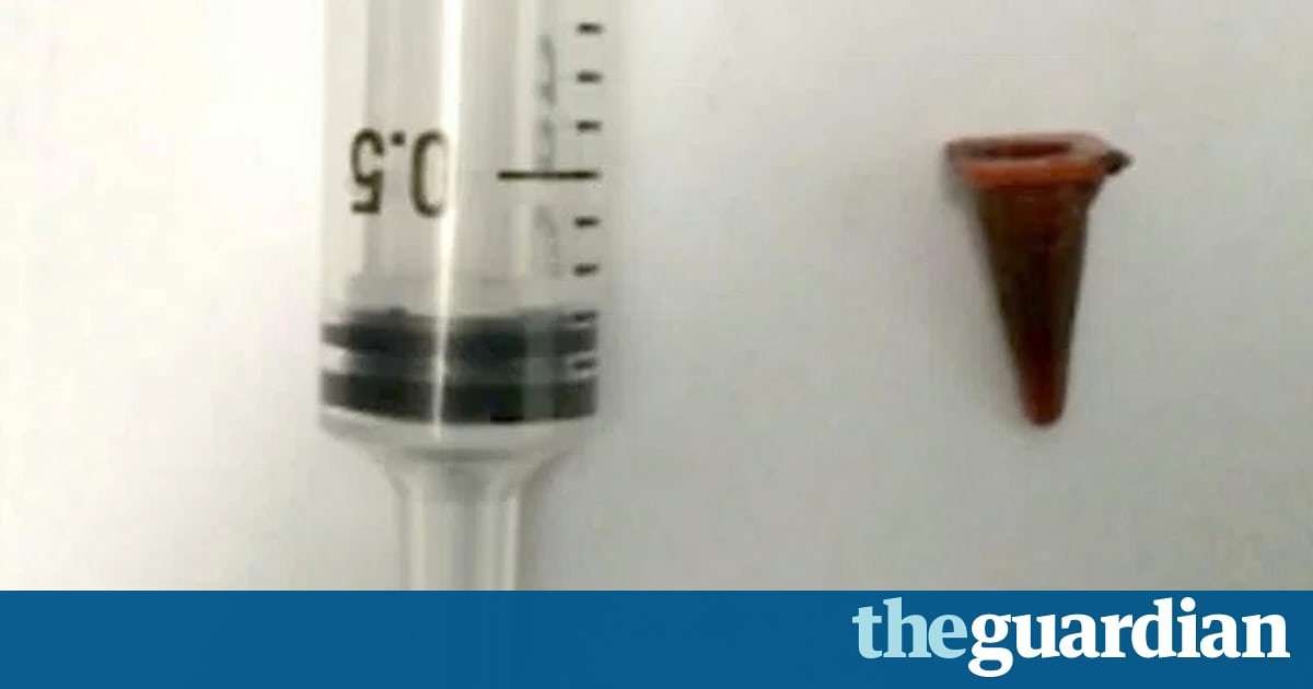 image for 'Cancer patient' finds lump was toy traffic cone inhaled in 1977