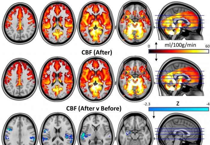 image for Magic mushrooms may 'reset' the brains of depressed patients