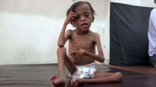 image for Yemen children are dying at a rate of 130 a day while Saudi-led blockade continues
