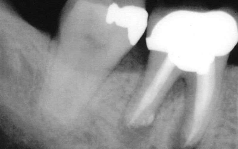 image for The End Of Root Canals: Stem Cell Fillings Trigger Teeth To Repair Themselves, Research Study Claims