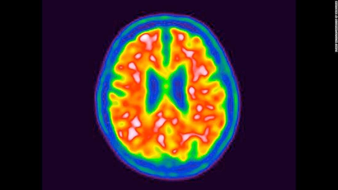 image for Blood test detects proteins linked to Alzheimer's disease