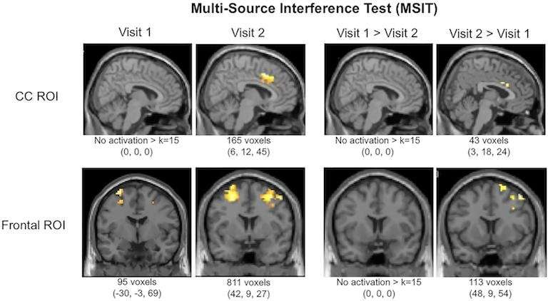 image for Patients’ Brain Function Improve Using Cannabis for 3 Months