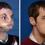 image for Incredibly well performed facial transplant