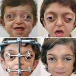 image for Facial reconstruction on a child with Crouzon Syndrome