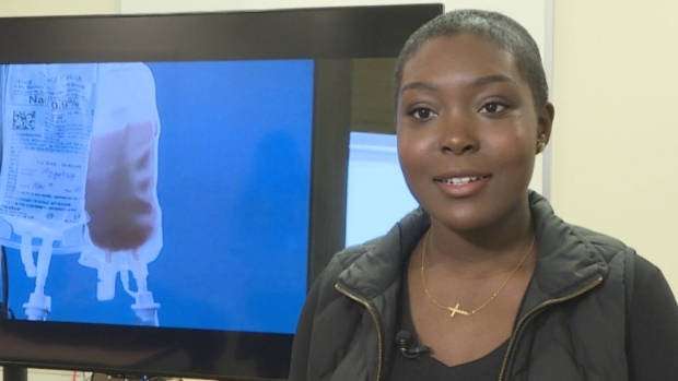 image for Alberta woman 1st adult in Canada to be 'cured' of sickle cell anemia through stem cell transplant