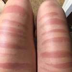 image for My cousin’s legs after a day in the sun in ripped jeans