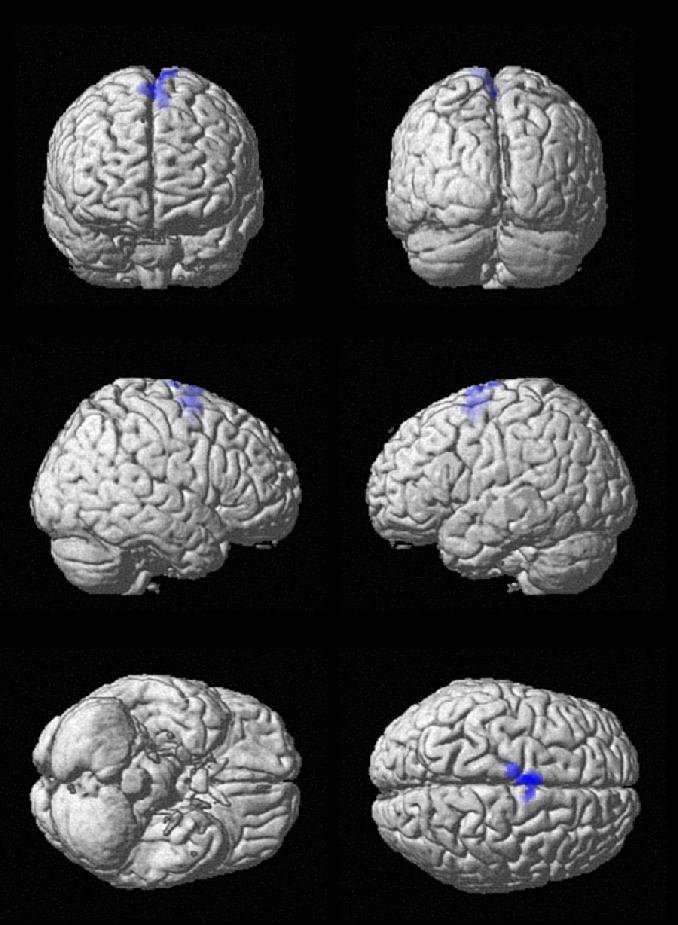 image for Music activates regions of the brain spared by Alzheimer's disease