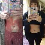image for A different kind of progress pic- Five months worth of treatment to cure severe plaque psoriasis