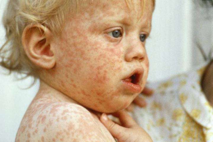 image for 37 dead as measles cases spike in Europe