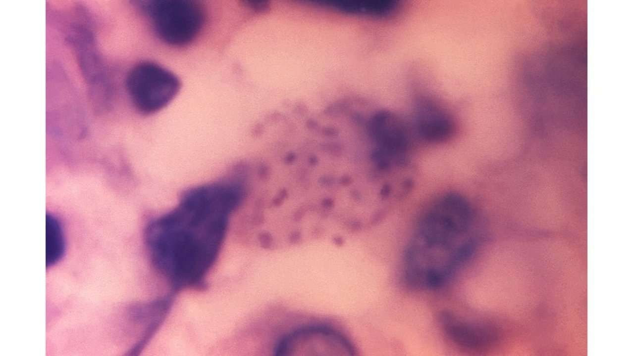 image for 'Flesh-eating' STD reported in UK for first time