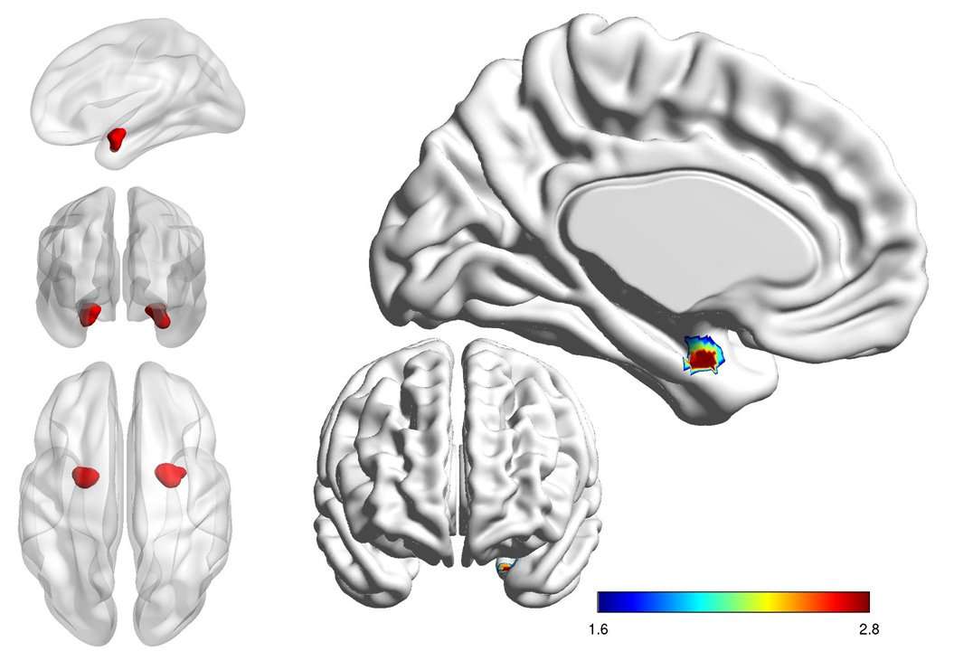 image for Looking inside the brain to distinguish bipolar from depression