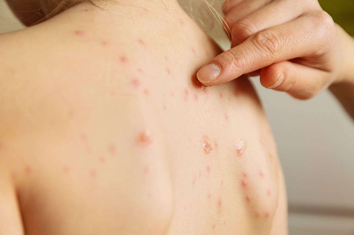 image for Anti-vaccination stronghold in N.C. hit with state’s worst chickenpox outbreak in 2 decades