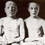 image for 2 boys both exposed to the same source of smallpox. One was vaccinated, the other was not.