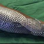 image for Doctors in Brazil are treating burn victims with fish skin. When applied to a burn, the fish skin keeps the burn moist. It also has high levels of collagen, which promotes healing.