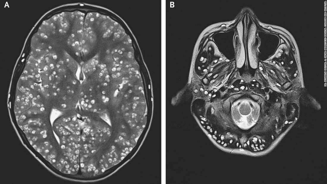 image for Teen dies of tapeworm egg infestation in brain