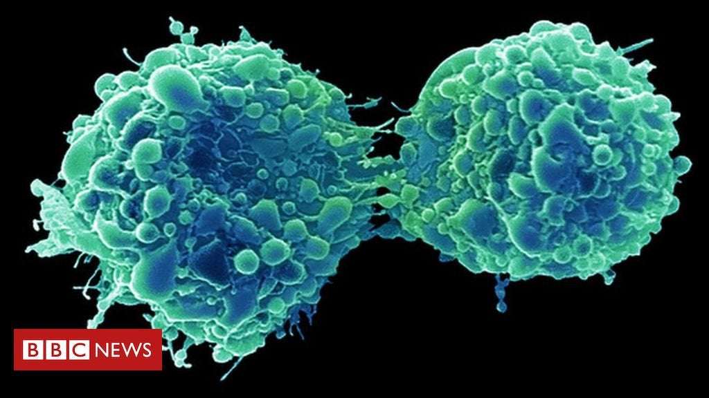 image for Bladder cancer 'attacked and killed by common cold virus'