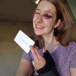 image for A rock climbing accident left me with a concussion, black eye, broken nose, and sprained wrist. How much damage can you do?