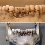 image for Dental work found on a 4,000 year old mummy.