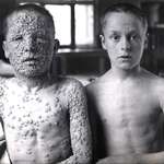 image for This photograph shows the dramatic differences in two boys who were exposed to the same Smallpox source – one was vaccinated, one was not.