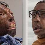 image for The First African American Man To Receive A Full Face Transplant Is ‘Thrilled’ With The Results