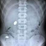 image for My kid swallowed a penny while showing his little brother how he accidentally swallowed a simm key the day before.