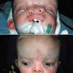 image for Before and after surgery for craniofacial duplication