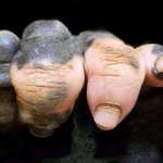 image for Gorilla Paw with Vitiligo
