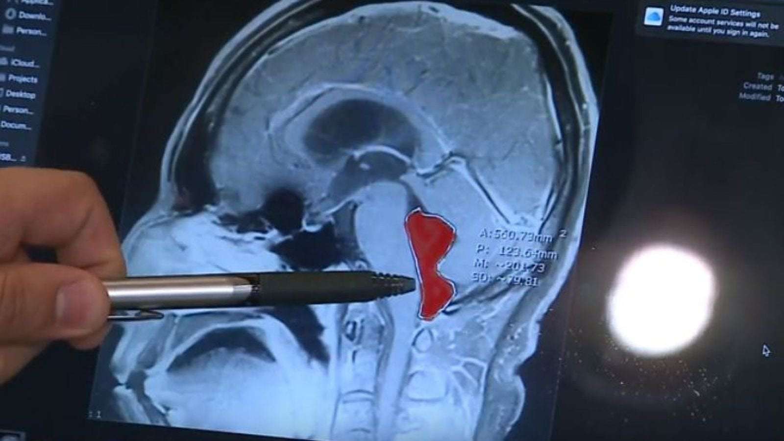 image for Man whose headaches made him vomit 'had tapeworm in brain for 10 years'