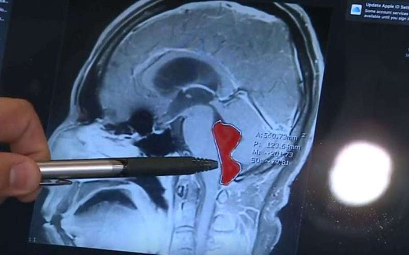 image for Man whose headaches made him vomit 'had tapeworm in brain for 10 years'