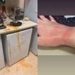 image for My submission for dumbest way to injure yourself: I burnt my hand taking tomato soup out of the microwave. The toast I was making popped up and it scared me.
