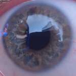 image for The stitches in my eye after my cornea transplant
