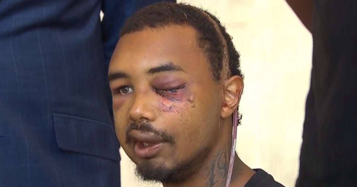 image for Dallas man loses eye to "non-lethal" police round during George Floyd protest, attorneys say