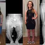 image for A patient with achondroplasia (dwarfism) before & after one arm lengthening and two leg lengthening treatments. She started at her mature height of 3’10” and now is 4’11, and she gained 4 inches of arm length.