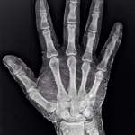 image for X-ray of a hand dipped in iodine. Iodine absorbs X-rays, revealing the skin around the bones.