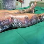 image for Certain fish skin can be grafted onto burns and diabetic wounds. The material recruits the body's own cells and is converted eventually into living tissue.