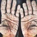 image for Two-time Olympic rowing champion Alex Gregory posted a photo of his hands after a 12-day rowing boat trip across the Arctic Ocean.