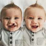 image for cleft lip and cleft palate, two week surgery