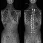 image for 6 years ago today I had a surgery to straighten up my spine, this is the before/after result. I gained 5cm with the process.