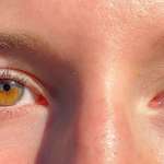 image for I have partial heterochromia in both eyes