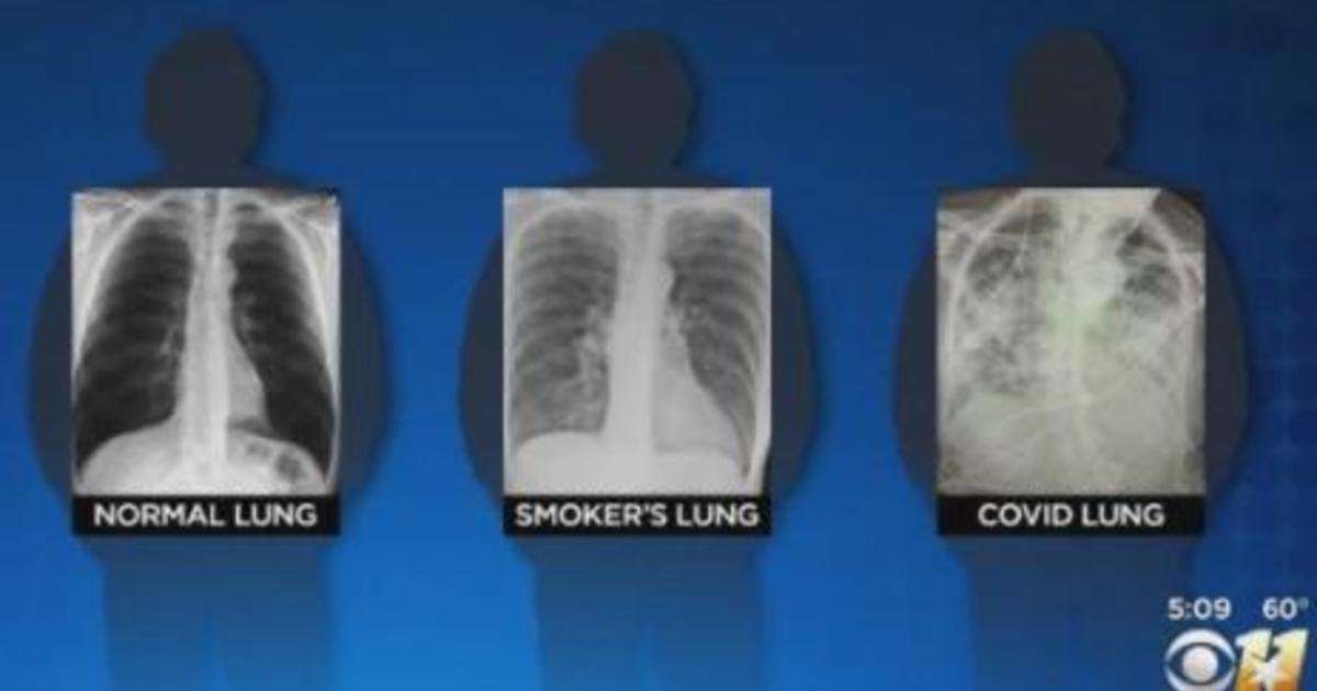 image for Post-COVID lungs worse than the worst smokers' lungs, surgeon says