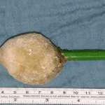 image for A 14 year old girl went to hospital with a kidney infection and doctors found this kidney stone pencil. She stuck the pencil up her urethra and into her bladder which caused a stone to form around the pencil.