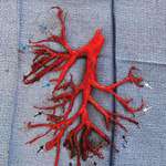 image for A blood clot coughed up by a patient that perfectly shaped the lung’s cavity it filled.