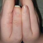image for The right joint of my thumb never developed. I can't bend it.