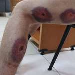 image for Injuries from rubber bullets on the human body